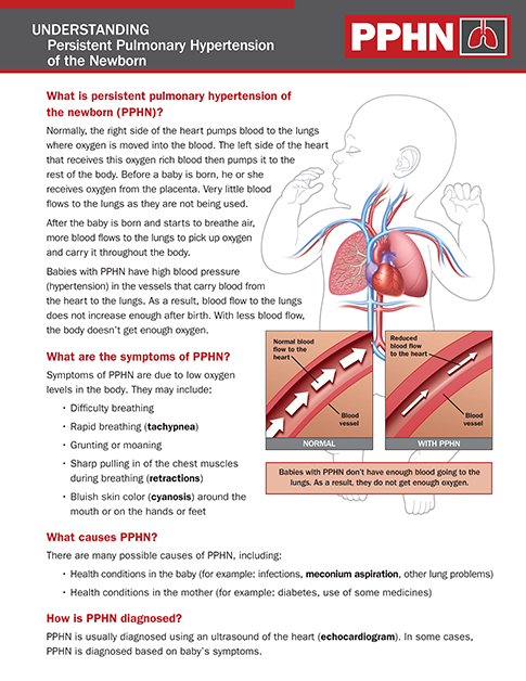 Pulmonary shop hypertension newborn